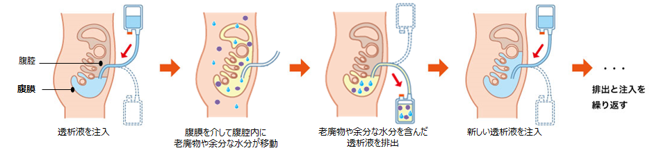 腹膜透析の仕組み