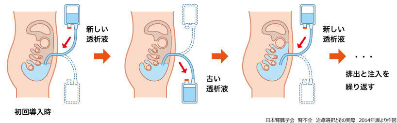 腹膜透析