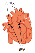 CABG