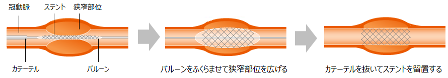 ステント留置