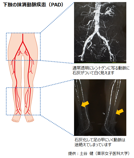 下肢の動脈硬化