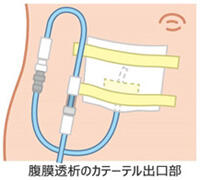 腹膜透析の出口部